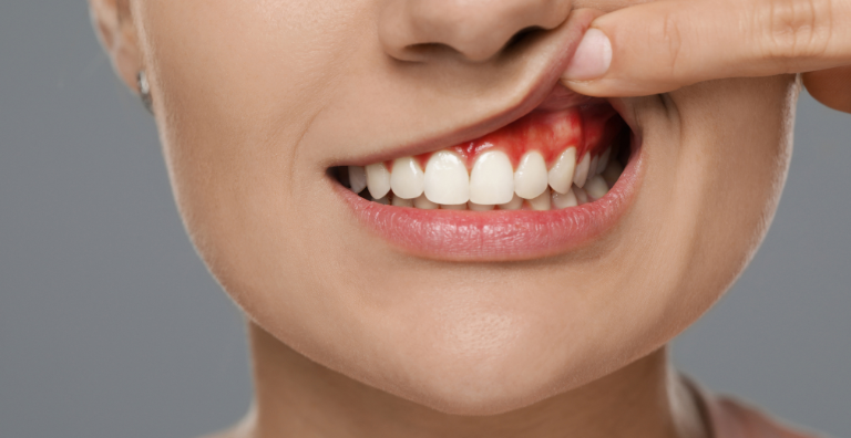 Gum Disease Treatment - best dental care in usa - dental quest lowell
