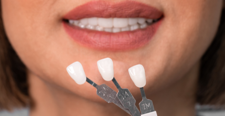 Porcelain Veneers - best dental care in usa - dental quest lowell