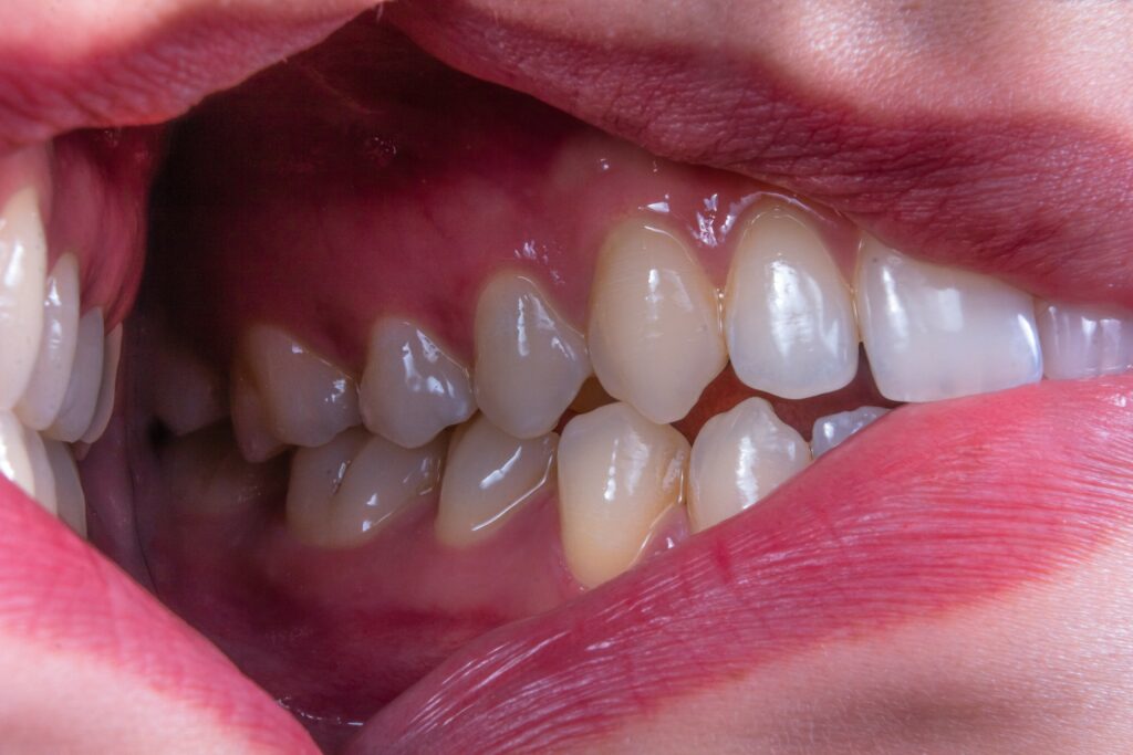 Gum Disease Affects
