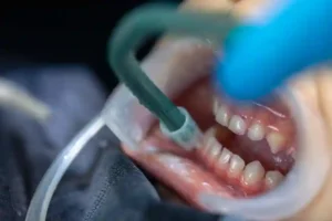 Deep Cleaning Explained