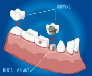 Dental Crown vs. Filling