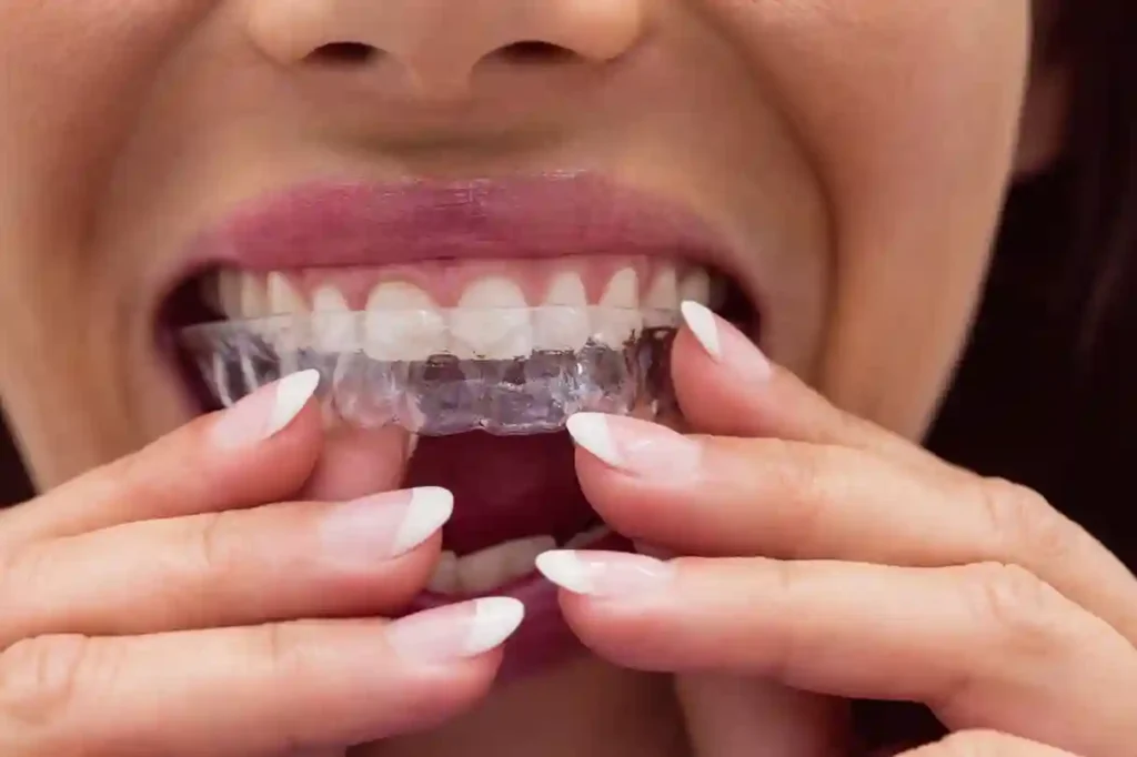 Does Invisalign Take in Lowell